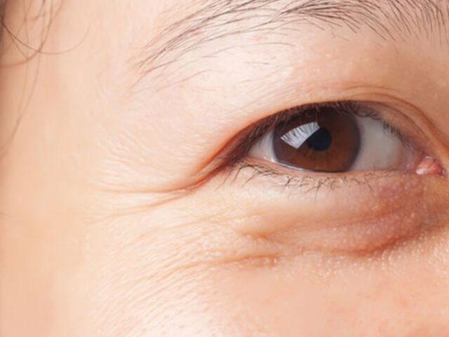 Mí sụp có nên nhấn mí hay không