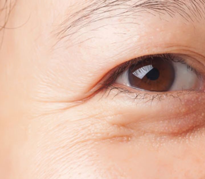 Mí sụp có nên nhấn mí hay không